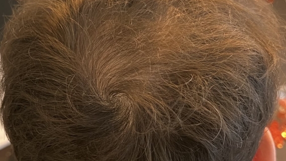 Efter-billede efter fire behandlinger PRP