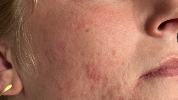 Laserbehandling mod akne ar på kosmetisk klinik Fyrsterling Clinic i Odense på Fyn