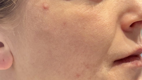 Laserbehandling mod akne ar på kosmetisk klinik Fyrsterling Clinic i Odense på Fyn