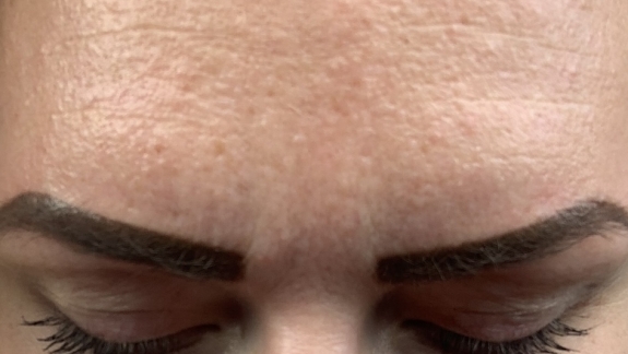 Før/efter billeder med ZO Skin Health hos Fyrsterling Clinic