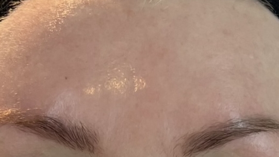 Før/efter billeder med ZO Skin Health hos Fyrsterling Clinic