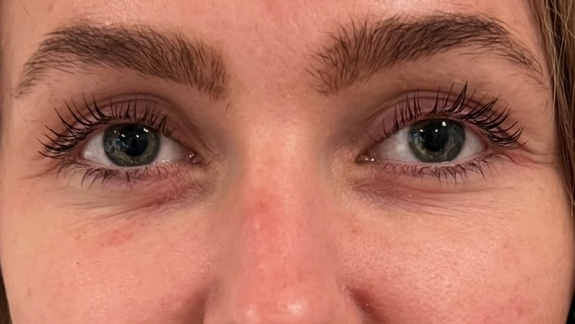 PRF behandling hos Fyrsterling Clinic i Odense på Fyn nær Svendborg