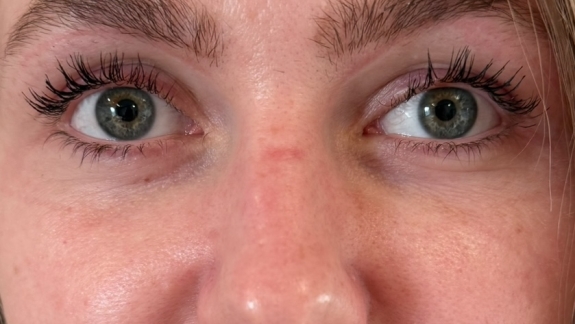 PRF behandling hos Fyrsterling Clinic i Odense på Fyn nær Svendborg