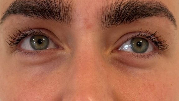 PRF skinbooster behandling hos Fyrsterling Clinic i Odense