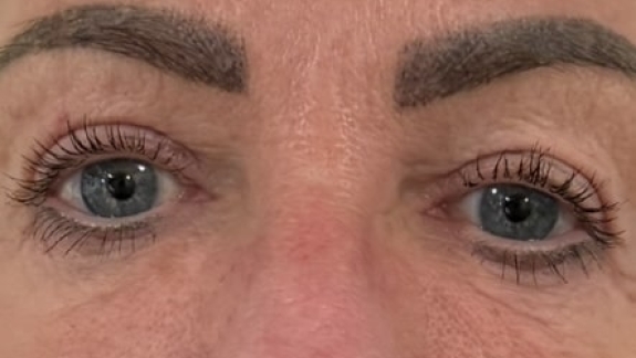 Kunder der har fået botox for brynløft hos Fyrsterling Clinic i Odense