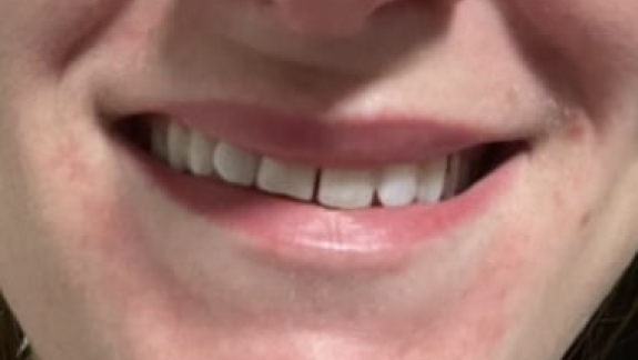 Botox behandling med lipflip til kunde hos skønhedsklinik i Odense