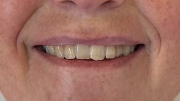 Kunder der har fået botox for lipflip hos kosmetisk klinik på Fyn