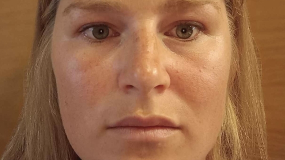 Masseter botox på kunde efter behandling