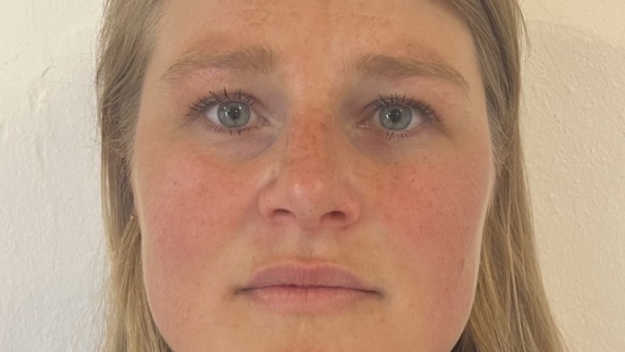 Masseter botox på kunde før behandling