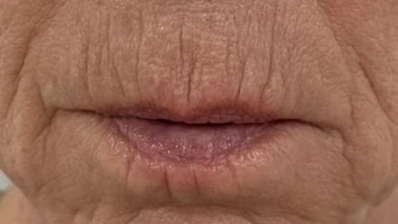 Kunde med rygerynker før behandling hos kosmetisk klinik i Odense på Fyn