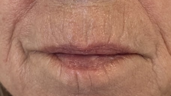 Kunde med rygerynker efter første behandling hos kosmetisk klinik i Odense