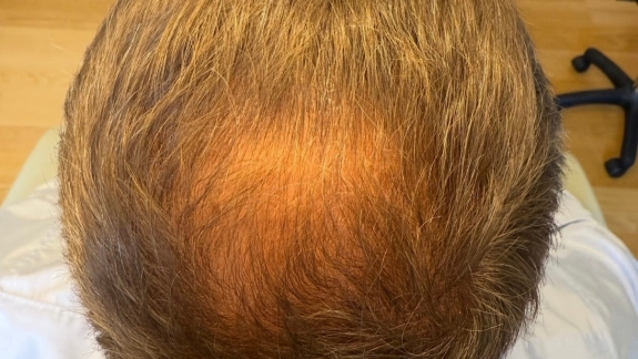 Behandling mod hårtab hos Fyrsterling Clinic i Odense