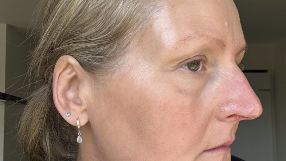 Efter behandling med IPL og ZO Skin Health