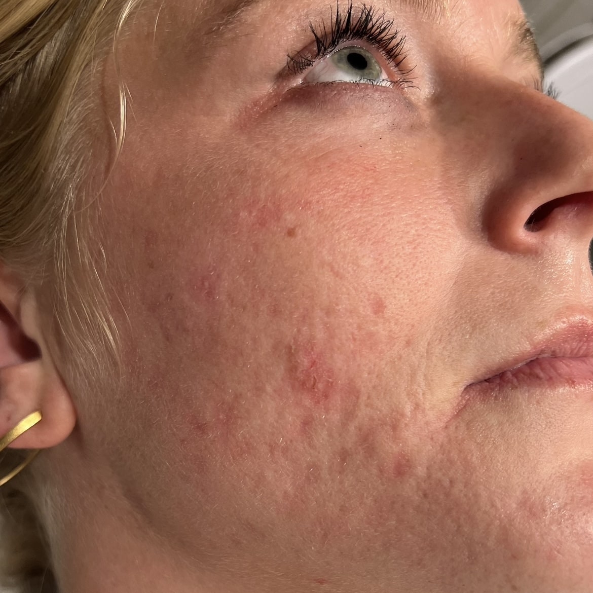 Kunde der får behandling mod sine akne ar i kosmetisk klinik i Odense
