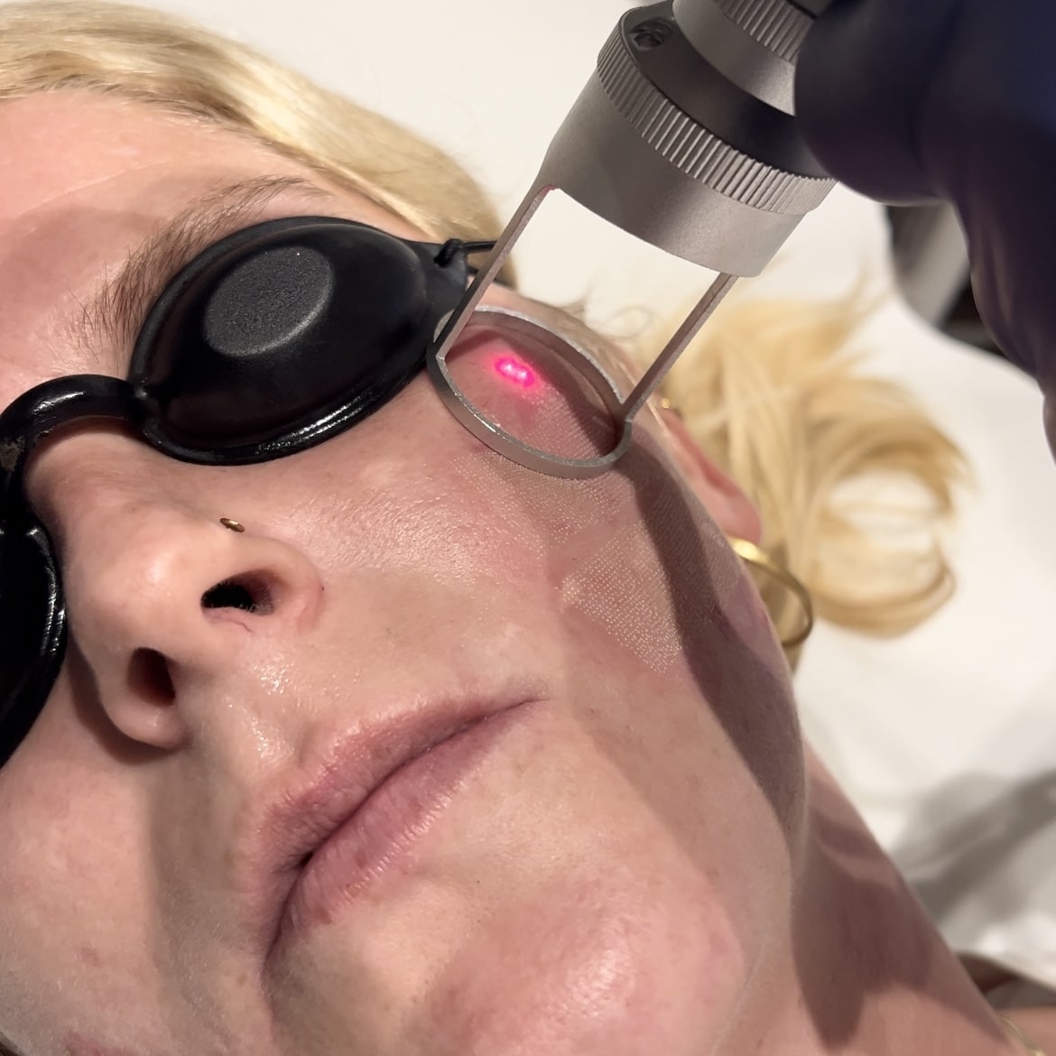 Kunde der fået fraktioneret CO2 laser hos speciallægeklinik i Odense