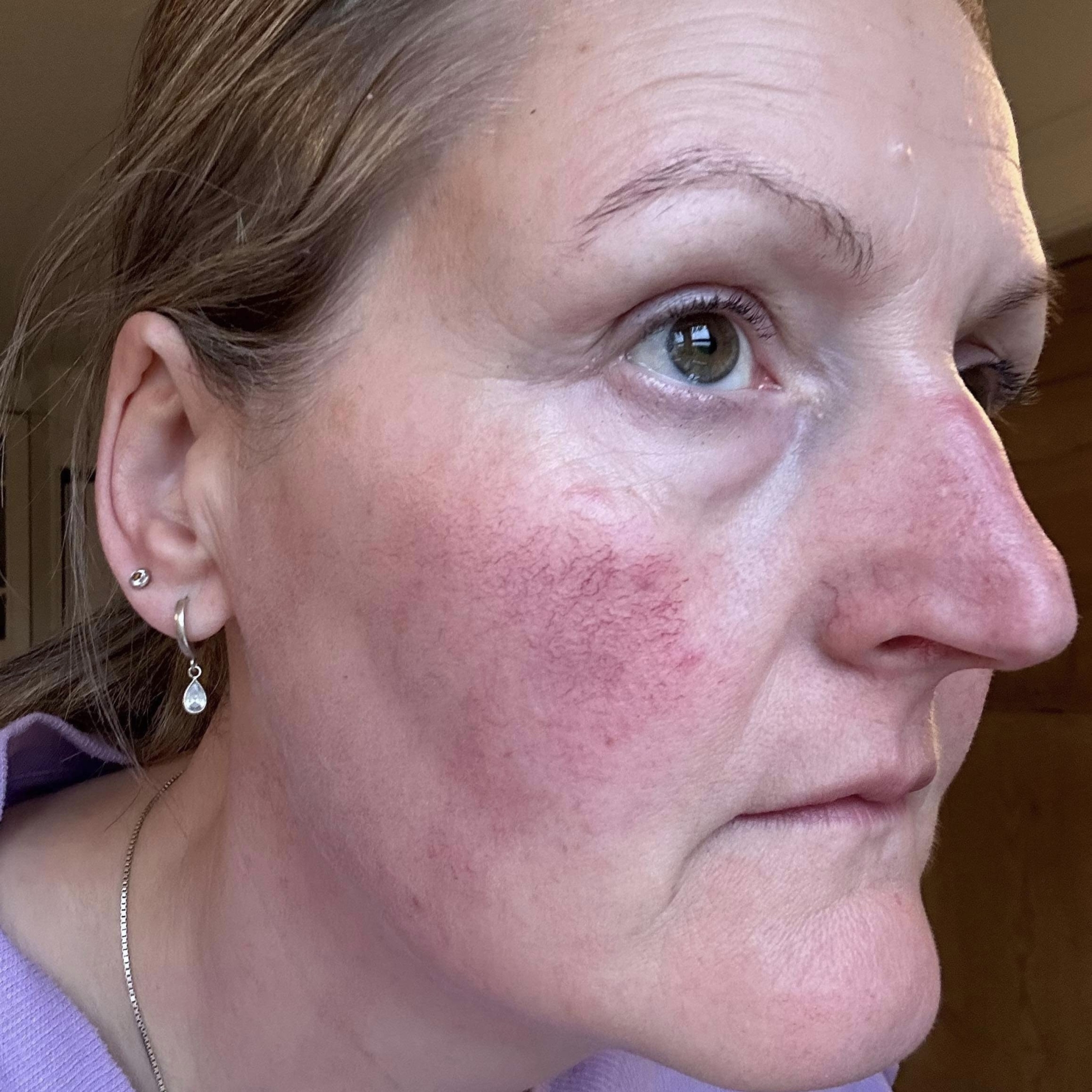 Rosacea kunde i kosmetisk klinik i Odense på Fyn nær Svendborg og Nyborg